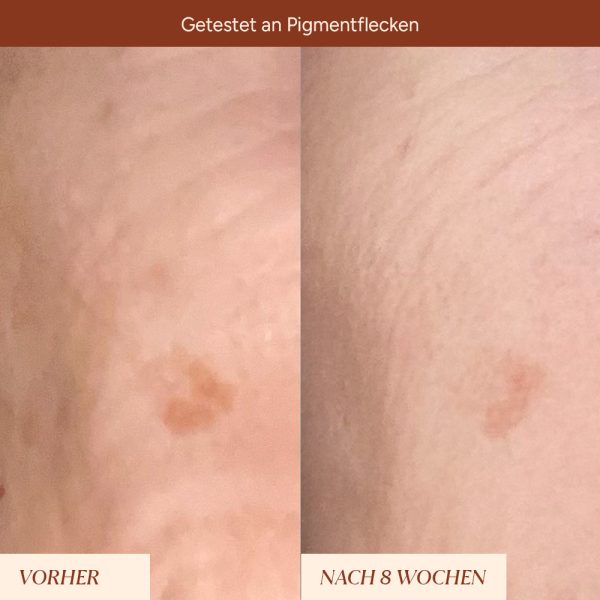 Set Pigmentflecken & Pickelmale aufhellen Online-Verkauf – Bild 4