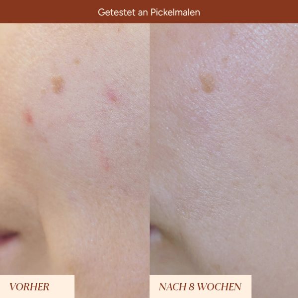 Set Pigmentflecken & Pickelmale aufhellen Online-Verkauf – Bild 5